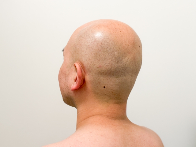 スキンヘッドがモテる国